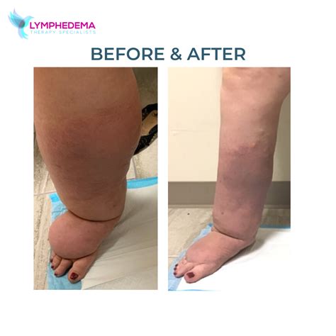 Photos Lymphedema Therapy Specialists