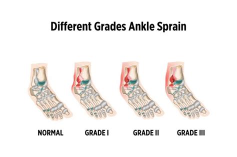 Ankle Sprains Different Types Grades Hot Sex Picture