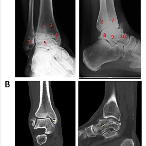 Outline Of Coronal And Sagittal Views Of The Tibia And Talus With