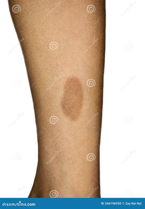 Birthmark On The Leg Of Asian Child It Is Congenital Benign