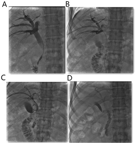 A Cholangiography Showing Stenosis Of The Common Bile Duct B The