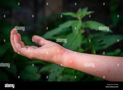 A Boys Arm With A Rash Caused By A Stinging Nettle Stock Photo Alamy