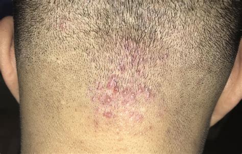 How Antifungal Shampoo For Folliculitis Can Benefit You Ds