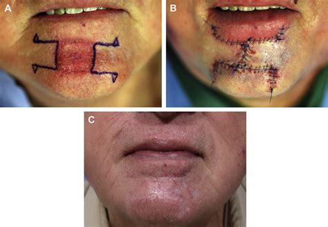 Reconstruction Of Mohs Defects Of The Lips And Chin Facial Plastic