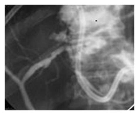 Ercp Demonstrating Bile Leak Into The Abscess Cavity After Percutaneous