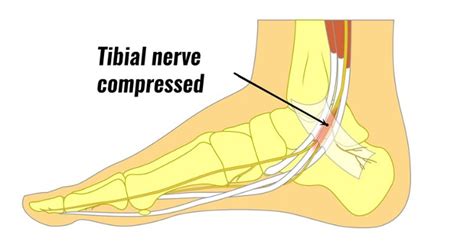 Tarsal Tunnel Syndrome Campbell Clinic Orthopaedics