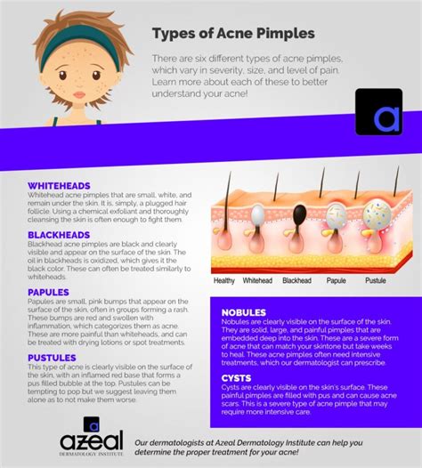 Acne Treatment - General Dermatology Services In Boulder | Azeal