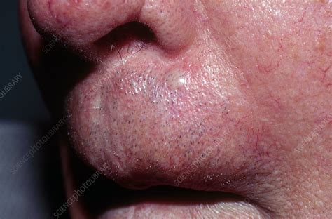 Basal Cell Carcinoma Above Lip Stock Image C Science