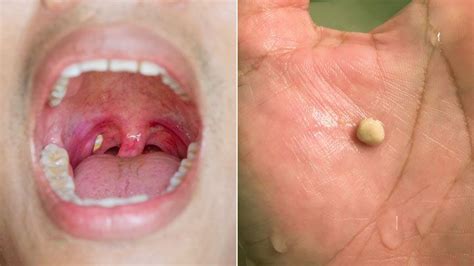 What Are Tonsil Stones Symptoms Causes Diagnosis Treatment And
