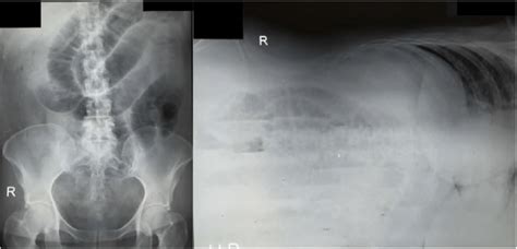 Abdominal Plain X Ray Supine And Left Lateral Decubitus Showed Fixed