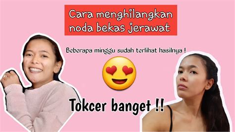 Ada cara menghilangkan jerawat yang tidak membahayakan. Cara menghilangkan bekas jerawat || Skincare noda jerawat ...