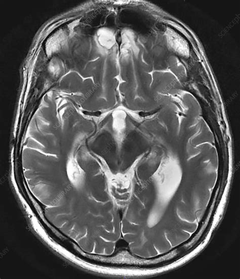 Chronic Post Traumatic Brain Injury Mri Stock Image C0306075