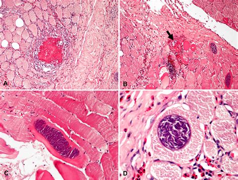 Sarcocystis Gigantea Infection Associated With Granulomatous