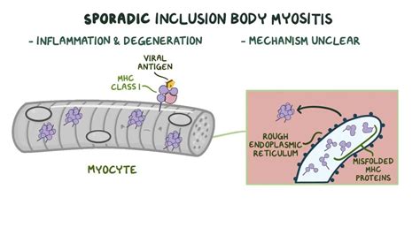 Inclusion Body Myopathy Video Anatomy And Definition Osmosis
