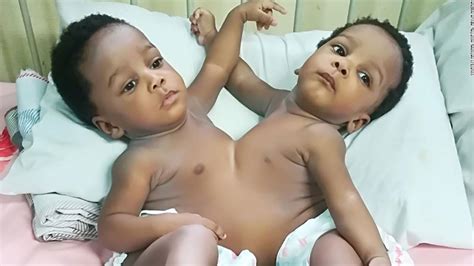 Nigerian Sisters Conjoined At The Chest And Abdomen Separated And Ready