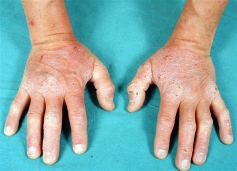 Dermatitis Herpetiformis Causes Symptoms Diagnosis And Treatment