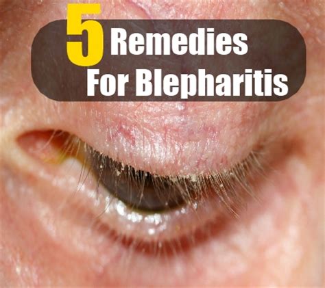 It can make your eyes swollen, watery and feel like the condition is not really something that can be cured, as people who get blepharitis tend to get it again, but there are ways you can help yourself keep it. 5 Herbal Remedies For Blepharitis - How To Treat ...