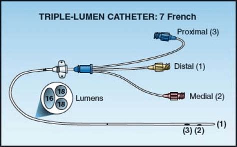Triple Lumen Catheter Proximal Medial And Distal