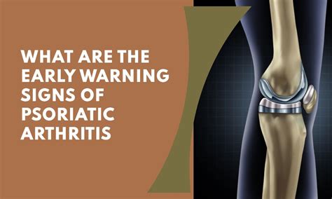What Are The Early Warning Signs Of Psoriatic Arthritis Hospitalninojesus