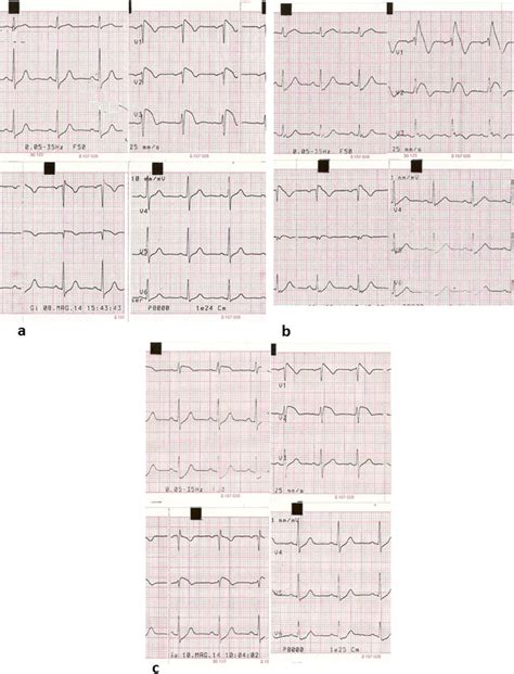 The Patients Electrocardiographic Pattern On Three Different