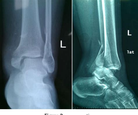 Pdf Posterolateral Approach In Trimalleolar Ankle Fracture Surgical