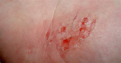Check These Interesting Facts About Abrasions