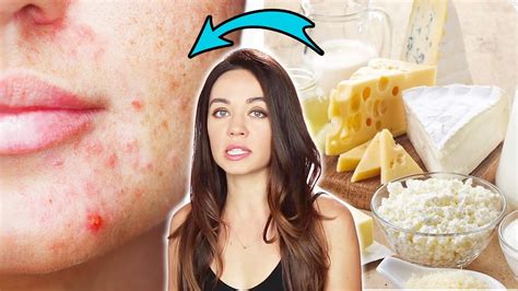 Nutritionists Reveal Which Foods Affect Your Acne Youtube