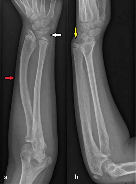 Cureus Radiotriquetral Ligament In Madelungs Deformity Associated