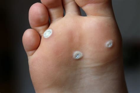 Warts On Your Toes