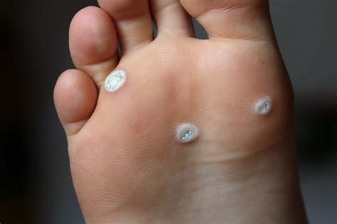 Warts On Feet Veruccas Plantar Warts Masterton Foot Clinic NZ