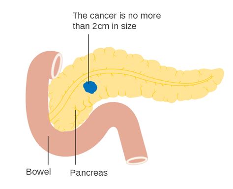Pancreatic Cancer Wikiprojectmed
