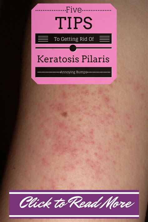 How Often Should You Exfoliate Keratosis Pilaris Oily Skin Beckley