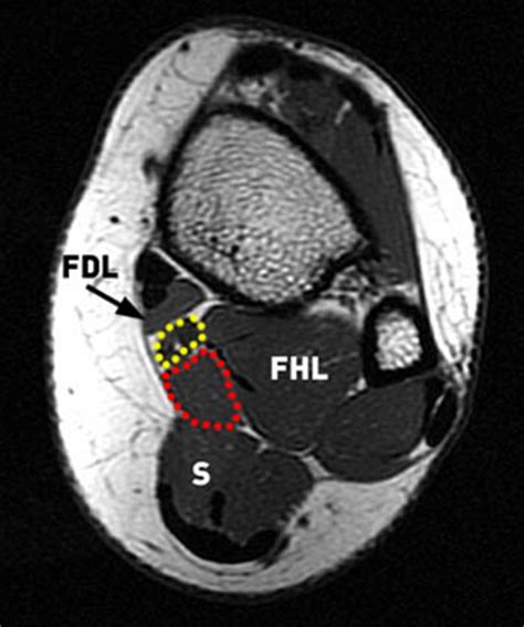 Neurovascular abnormalities and skin abnormalities in the affected limb were identified on mri in 1 and 2 patients, respectively. Accessory Muscles of the Ankle - Radsource