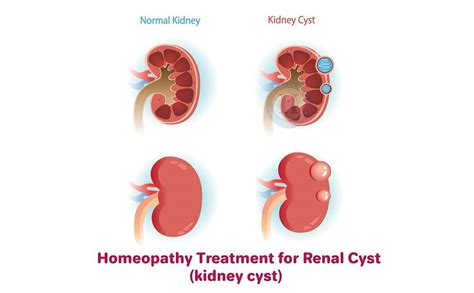 What Does A Cyst On The Kidney Mean