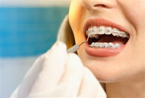 Brace Yourself Solihull A Guide To Adult Braces Options