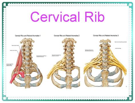 Cervical Rib Cervical Rib Medical History