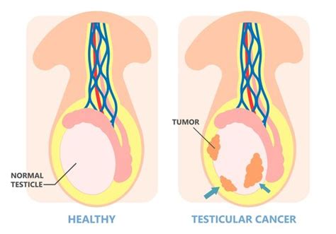 Best Testicular Atrophy Images Stock Photos Vectors Adobe Stock