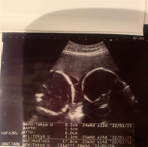 23週4日 双子妊婦検診 2回帝王切開後、3度目の妊娠で双子発覚 ハイリスク妊婦の記録