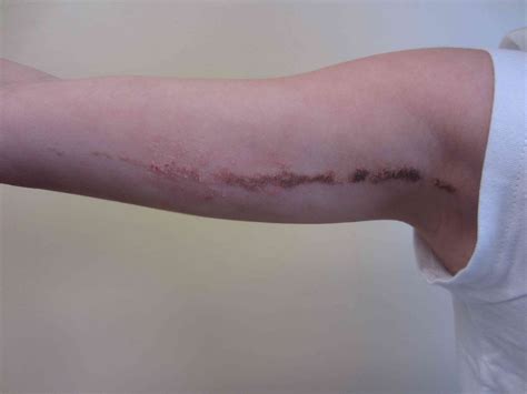 Blaschkos Lines And Invisible Stripes On Human Skin