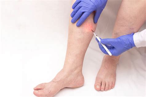 Vein Glue Vs Laser Treatment For Varicose Veins Which Is Better