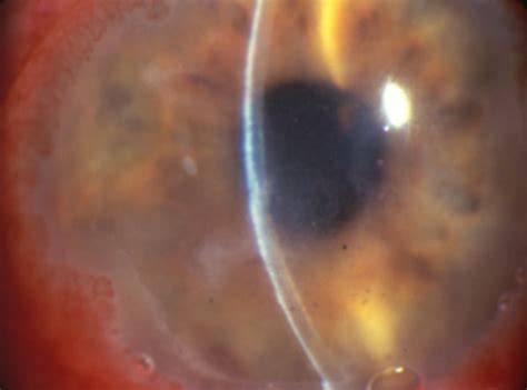 Formulary drug information for this topic. Herpes Simplex Keratitis