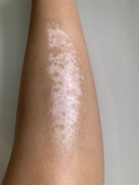 Skin Concern Treatment For Hypopigmentation From 1st Deg Burn Scar