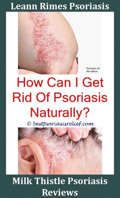 Nailpsoriasis Psoriasis What Does It Look Like Can Psoriasis On Scalp