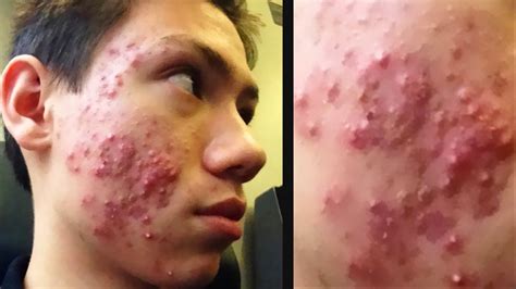 Comedonal Acne Worst Cystic Acne Ever Youtube