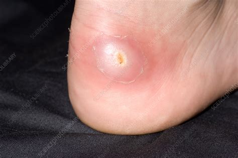 Heel Abscess Stock Image M1080753 Science Photo Library