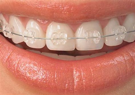 How Do Braces Work On Crowded Teeth Teethwalls