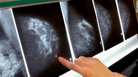 Global Study Reveals 72 Gene Mutations That Lead To Breast Cancer Cnn