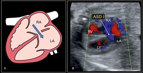Atrial Ventricular And Atrioventricular Septal Defects Obgyn Key In
