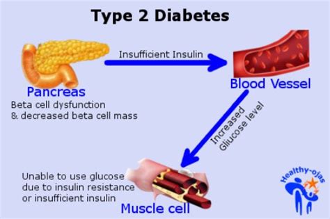 Gestational diabetes develops during pregnancy and causes high blood sugar that can affect your pregnancy and your baby's health. 10 Facts about Diabetes Type 2 | Fact File