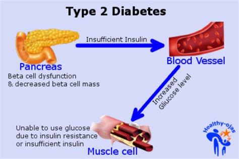 In the past, only two types of diabetes were known, type 1 and type 2. 10 Facts about Diabetes Type 2 | Fact File